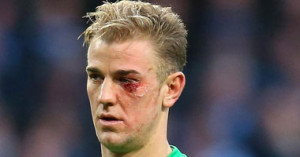 اصابة جو هارت 300x157 بالصور اصابة جو هارت في العين في مباراة مانشستر سيتي وكريستال بالاس