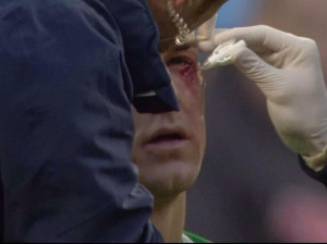 الحارس جو هارت 300x224 بالصور اصابة جو هارت في العين في مباراة مانشستر سيتي وكريستال بالاس